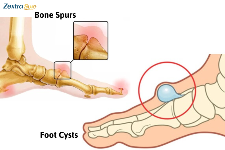 Foot cysts and bone spurs cause lump on top of foot, but they are benign and do not cause cancer